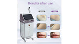 KuAn Technology Gold Super Photon Hair Removal Device