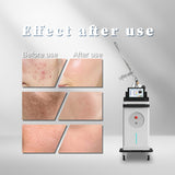 KuAn Technology CX-8 CO2 Fractional Laser